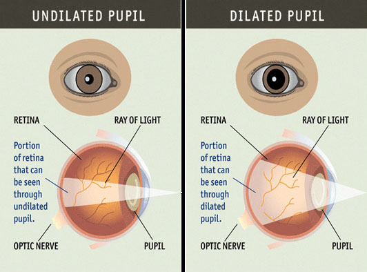 dilated pupil diagram